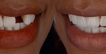 Dentures side by side - Essential Dental