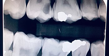 Digital X-ray