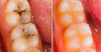 Tooth filling