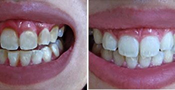 Gum treatment