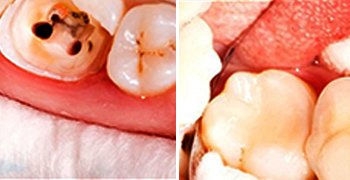 Root canal